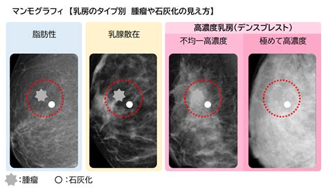 微細石灰化の集簇|乳がん／マンモグラフィ検査(3) 白い影が等間隔では。